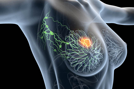 dépistage du cancer du sein